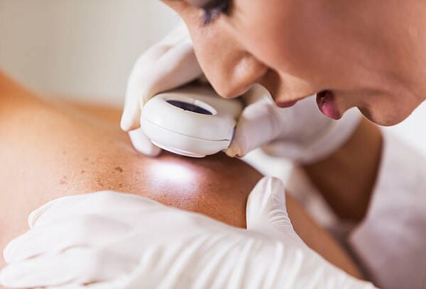 Skin Cancer Check App Cuts Referrals by 50%