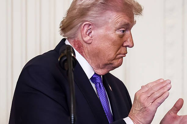 Trump’s Neck Redness Explained: What Skin Cream Reactions Mean